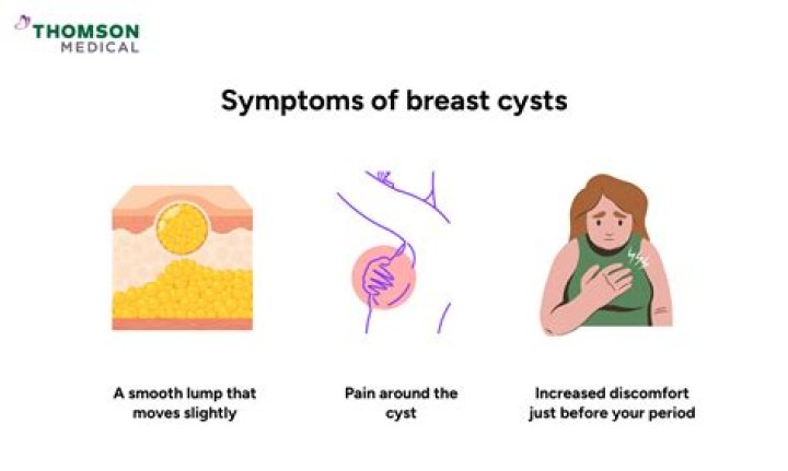 Soft breast cyst